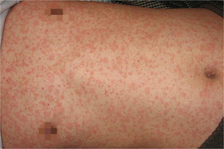 麻疹型药疹图 麻疹型药疹图