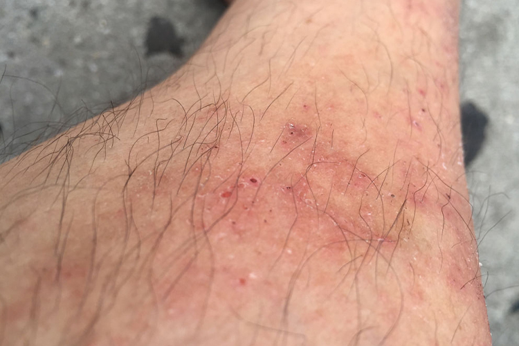 铁锈过敏症状图 铁锈过敏症状图