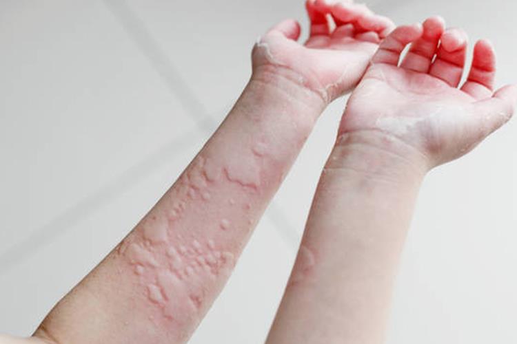 慢性自发性荨麻疹图