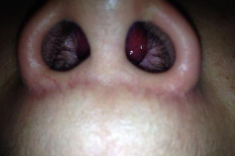 鼻孢子菌病鼻腔有光滑肉球图 鼻孢子菌病鼻腔有光滑肉球图