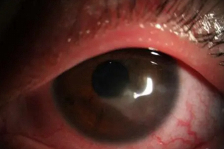 白塞病眼球充血有血丝图