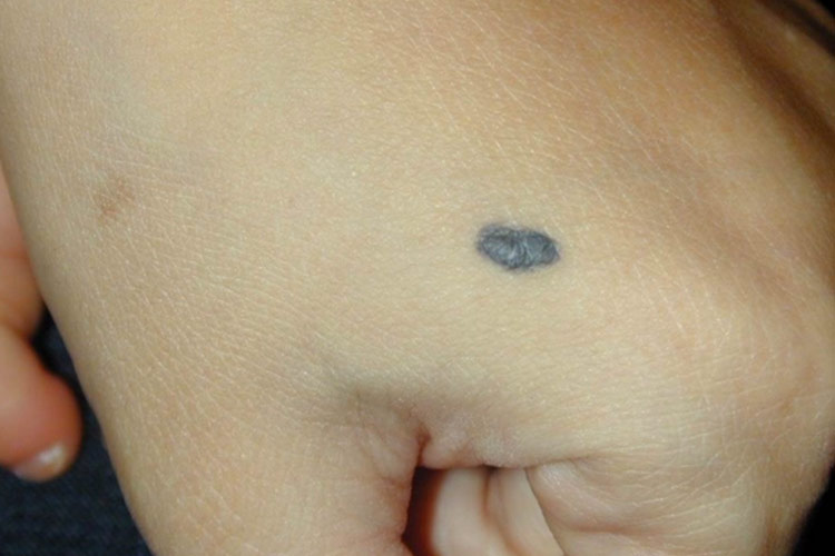 容易癌变的痣的图片早期症状_有来医生