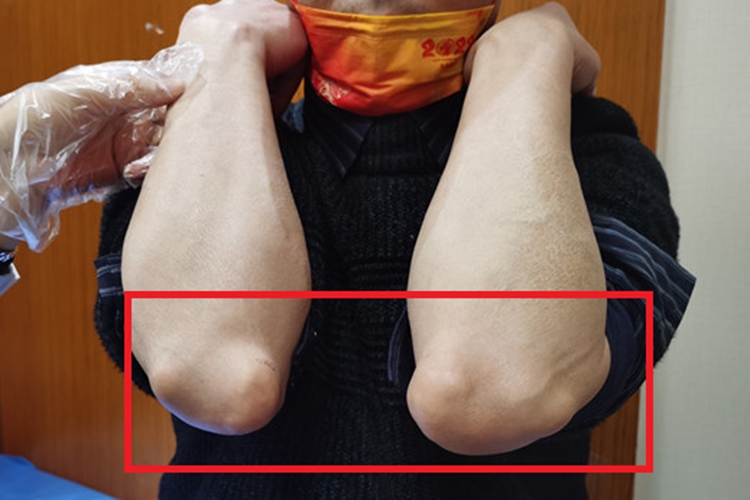 风湿性结节肘部疙瘩图