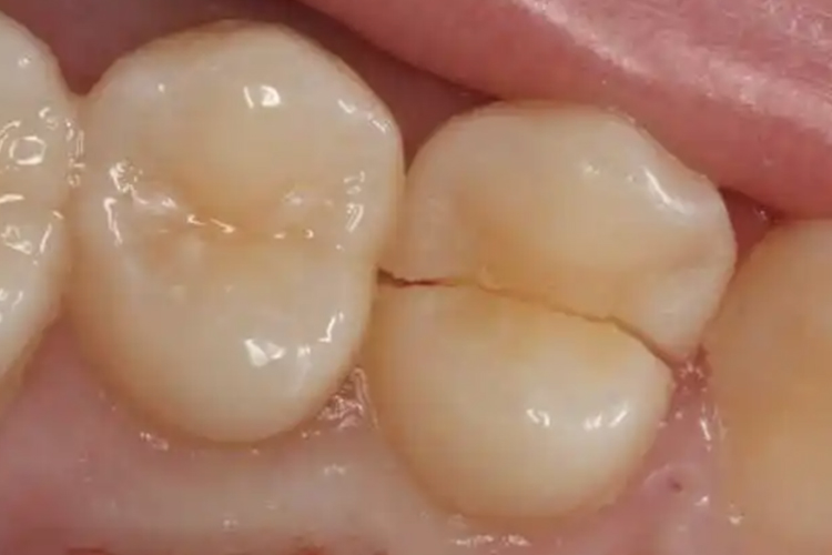 较深的牙隐裂图 较深的牙隐裂图