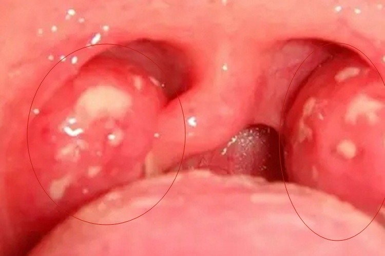 传染性单核细胞增多症图