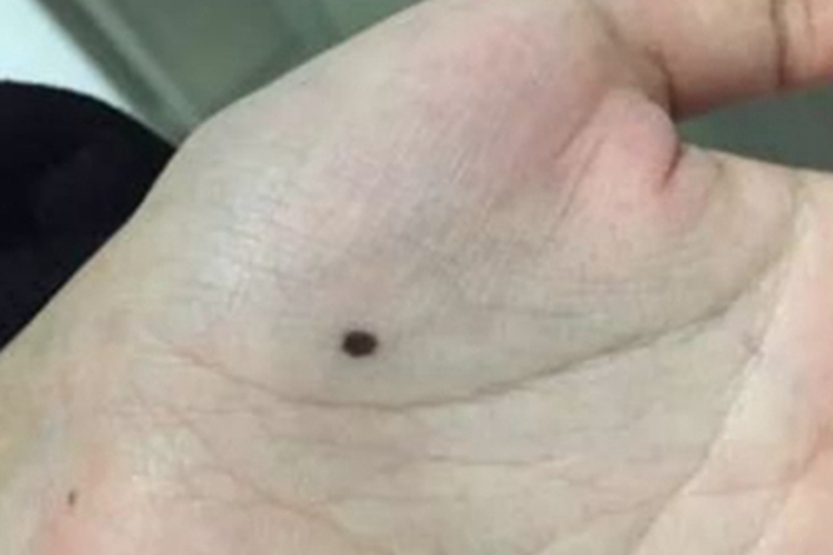 交界痣手掌长了个黑痣图