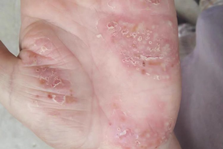 亚急性湿疹手掌症状图