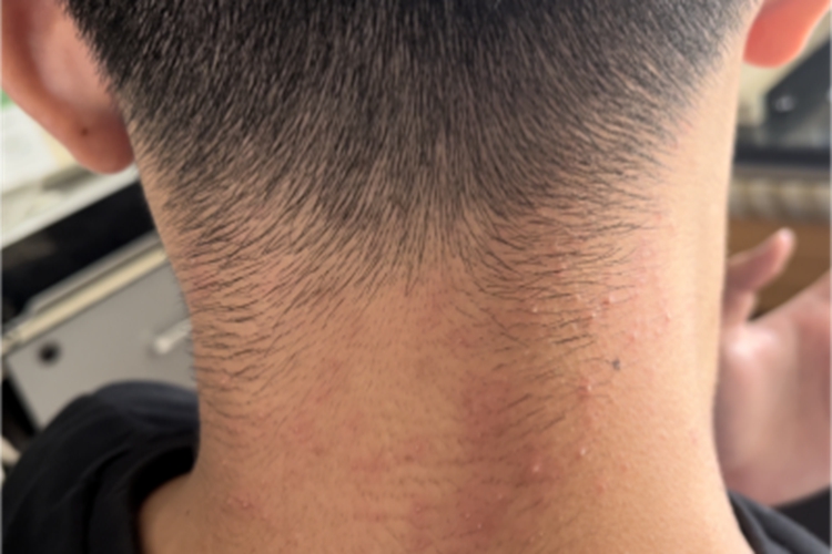 成人脂溢性皮炎后颈症状图