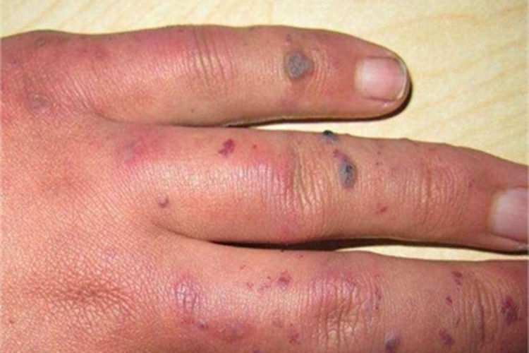 血管角化瘤手指小疙瘩图 血管角化瘤手指小疙瘩图