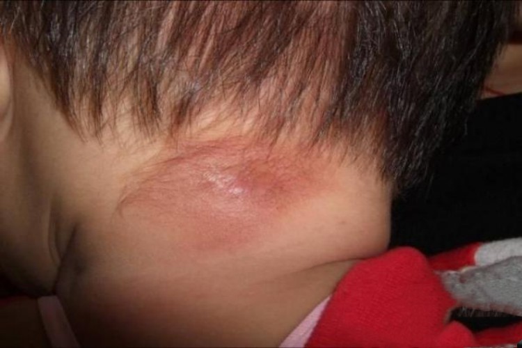 婴儿肥大细胞瘤的皮肤图 婴儿肥大细胞瘤的皮肤图