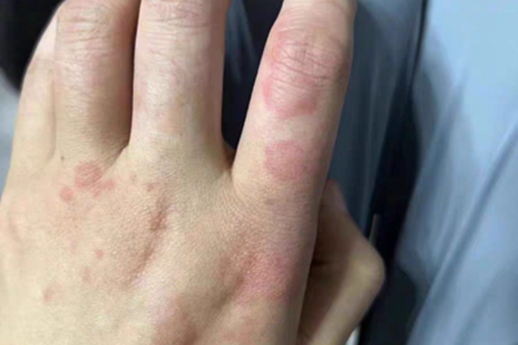 热接触性荨麻疹红斑图 热接触性荨麻疹红斑图