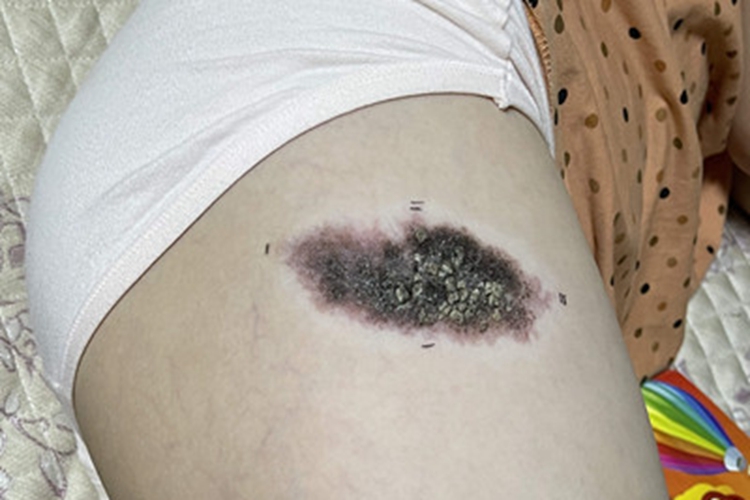 皮内痣大腿黑斑图