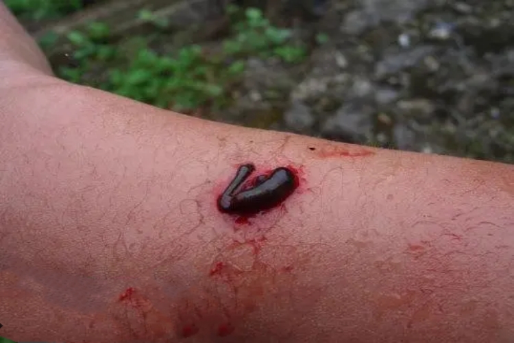 水蛭咬伤胳膊肿图 水蛭咬伤胳膊肿图