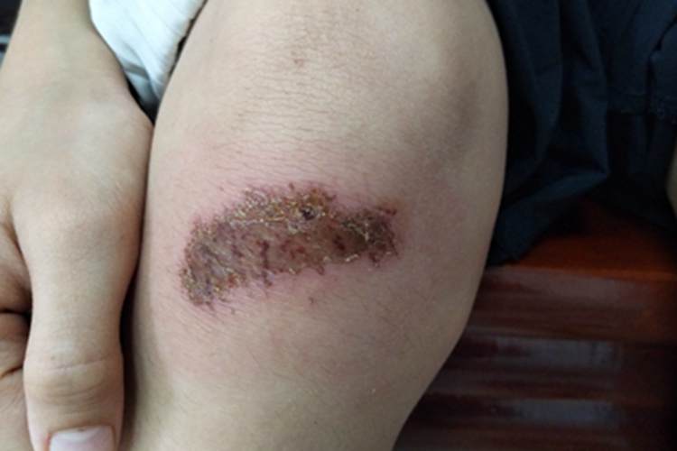 外伤感染结痂图 外伤感染结痂图