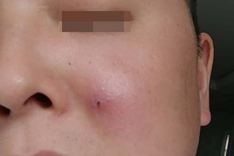 皮脂腺囊肿面部红肿图