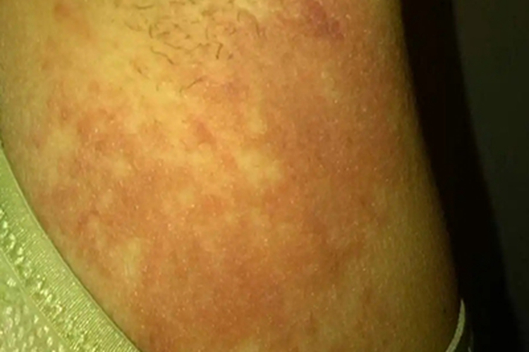 腋窝体癣图 腋窝体癣图