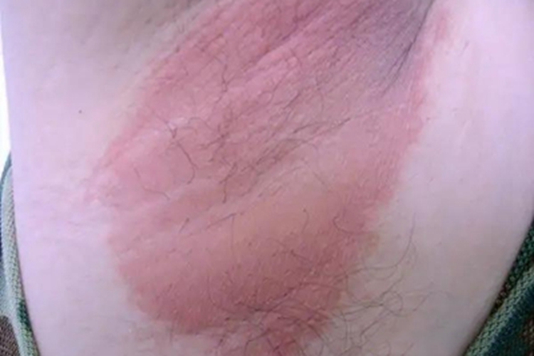 红癣腋窝有一大块红斑图