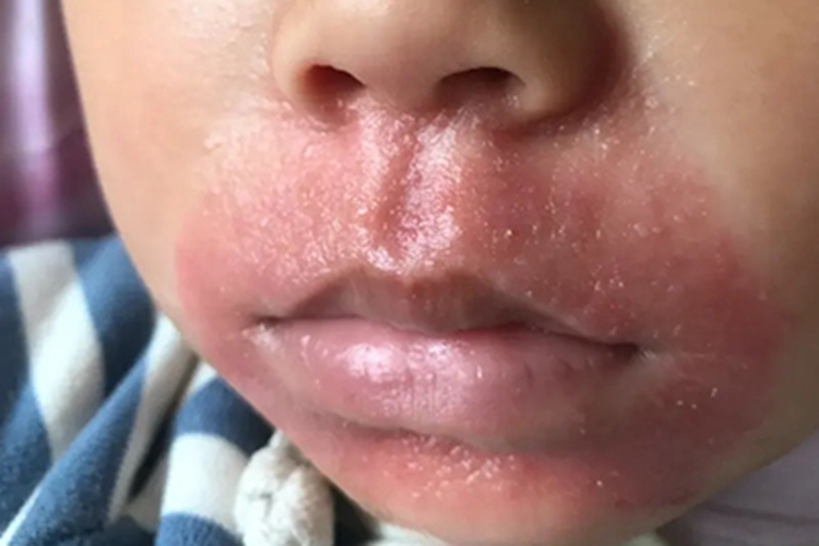 药物过敏性口炎口周症状图 药物过敏性口炎口周症状图