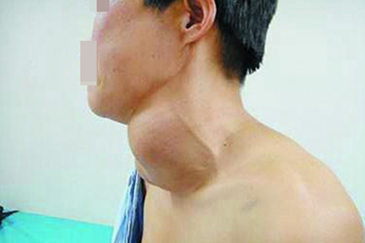结节性甲状腺肿畸形图 结节性甲状腺肿畸形图