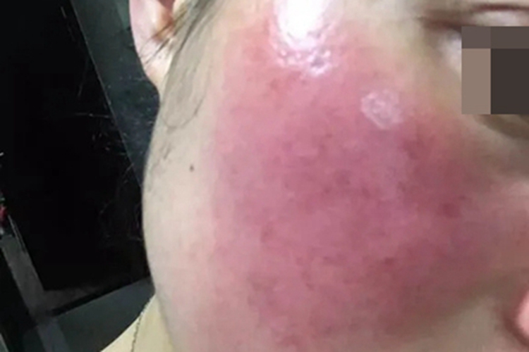 急性一氧化碳中毒面部红斑图 急性一氧化碳中毒面部红斑图