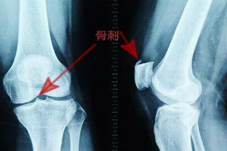 髌骨骨质增生影像图