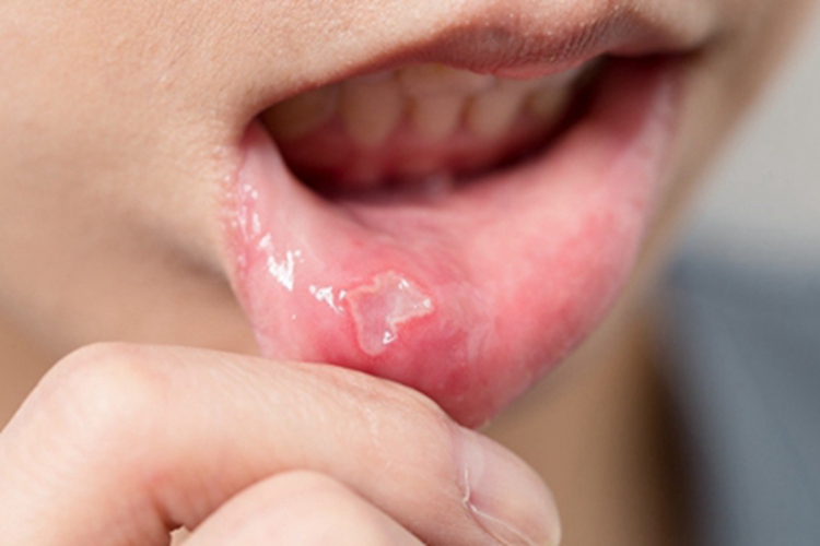 重型阿弗他溃疡大坑图