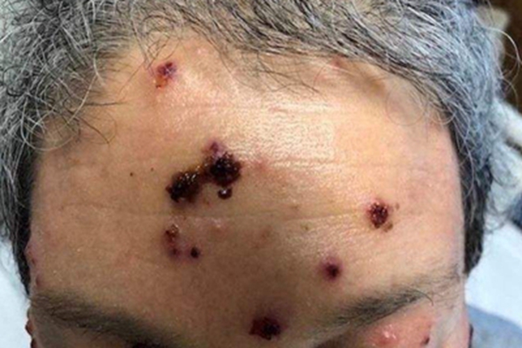 皮肤白血病前额症状图