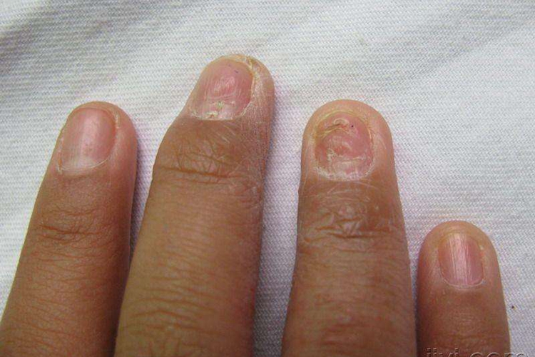 梅毒指甲凹陷图