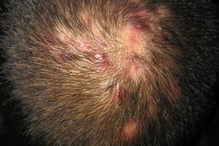 头虱病头皮症状图