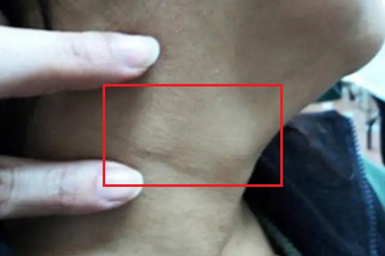 皮肤猪囊虫病颈部小疙瘩图 皮肤猪囊虫病颈部小疙瘩图