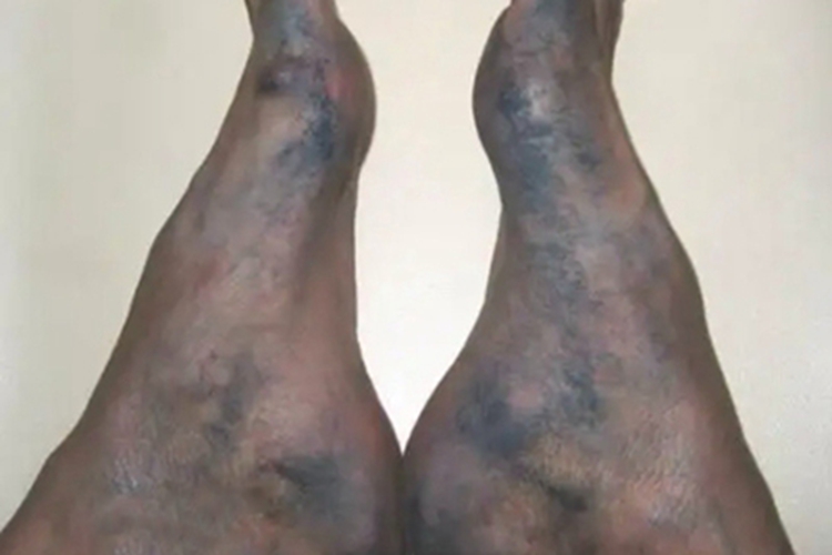 色汗症脚部症状图