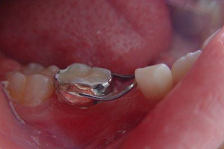 丝圈式间隙保持器图