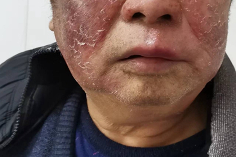 过敏性皮炎面部脱皮图