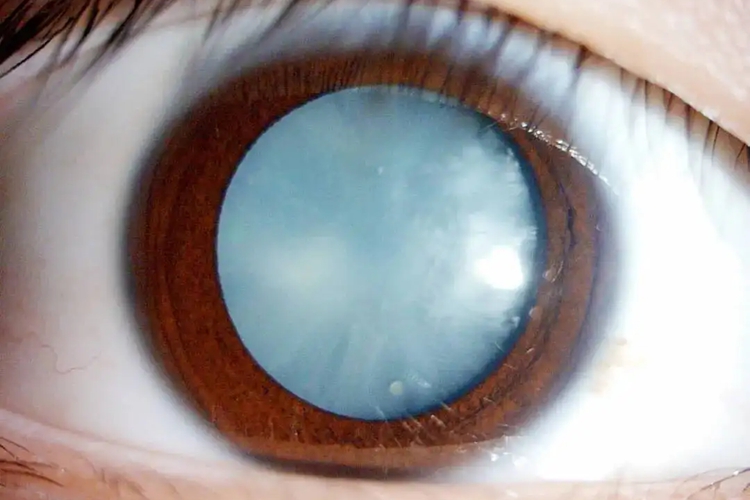 白内障成熟期图 白内障成熟期图