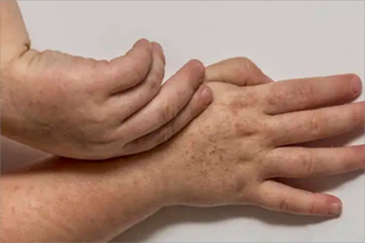 普通型猩红热手背丘疹图