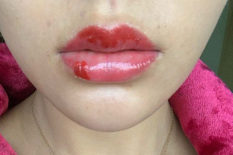 纹唇掉痂第二天图 纹唇掉痂第二天图