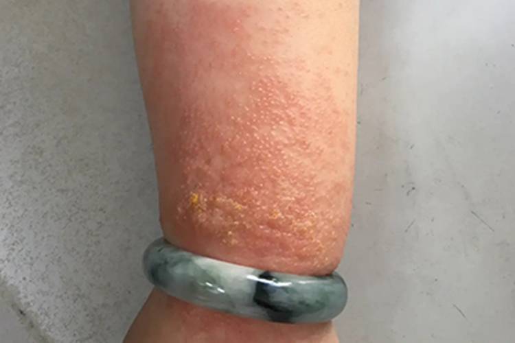 急性湿疹手臂小水疱图