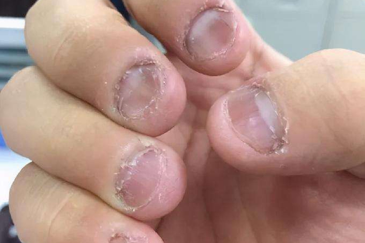 孩子咬指甲甲板翘起图