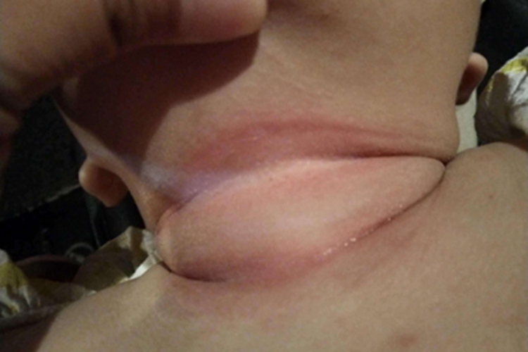 摩擦红斑脖子前面发红图 摩擦红斑脖子前面发红图