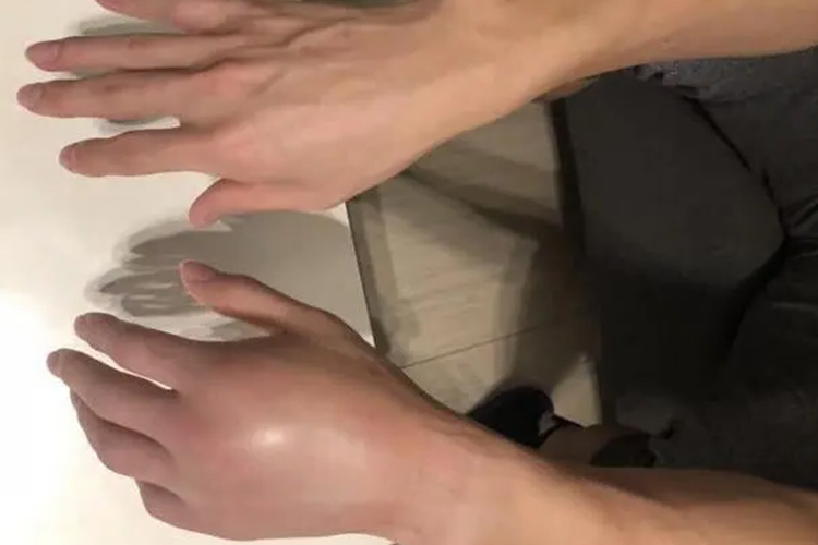 拳击手骨折图 拳击手骨折图