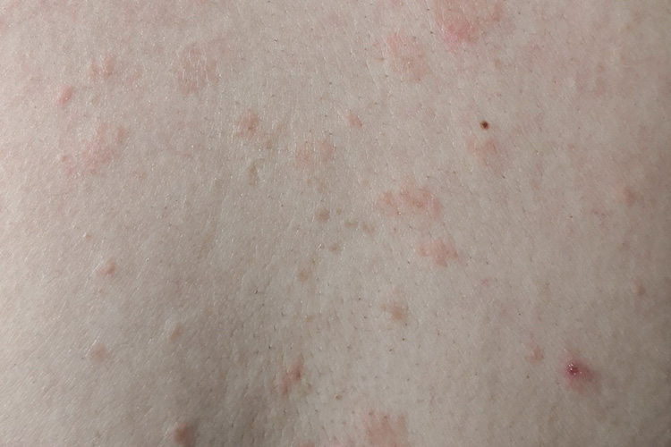 背部继发斑图
