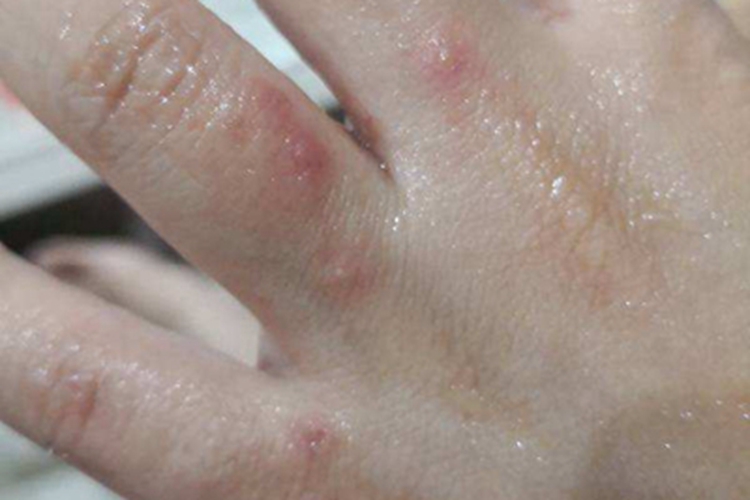 柯萨奇湿疹手指症状图