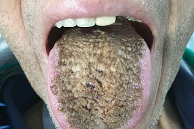 黑毛舌舌头长黄色的毛图