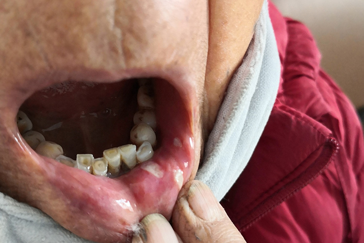 口腔黏膜损害图