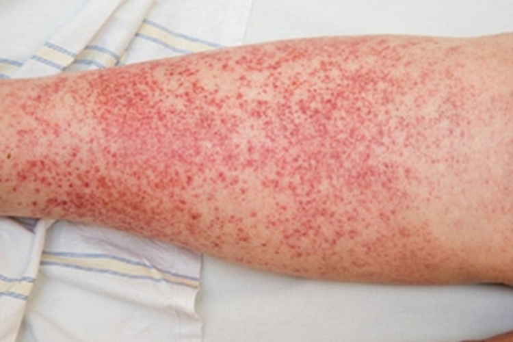 皮肤小血管炎小腿红点图