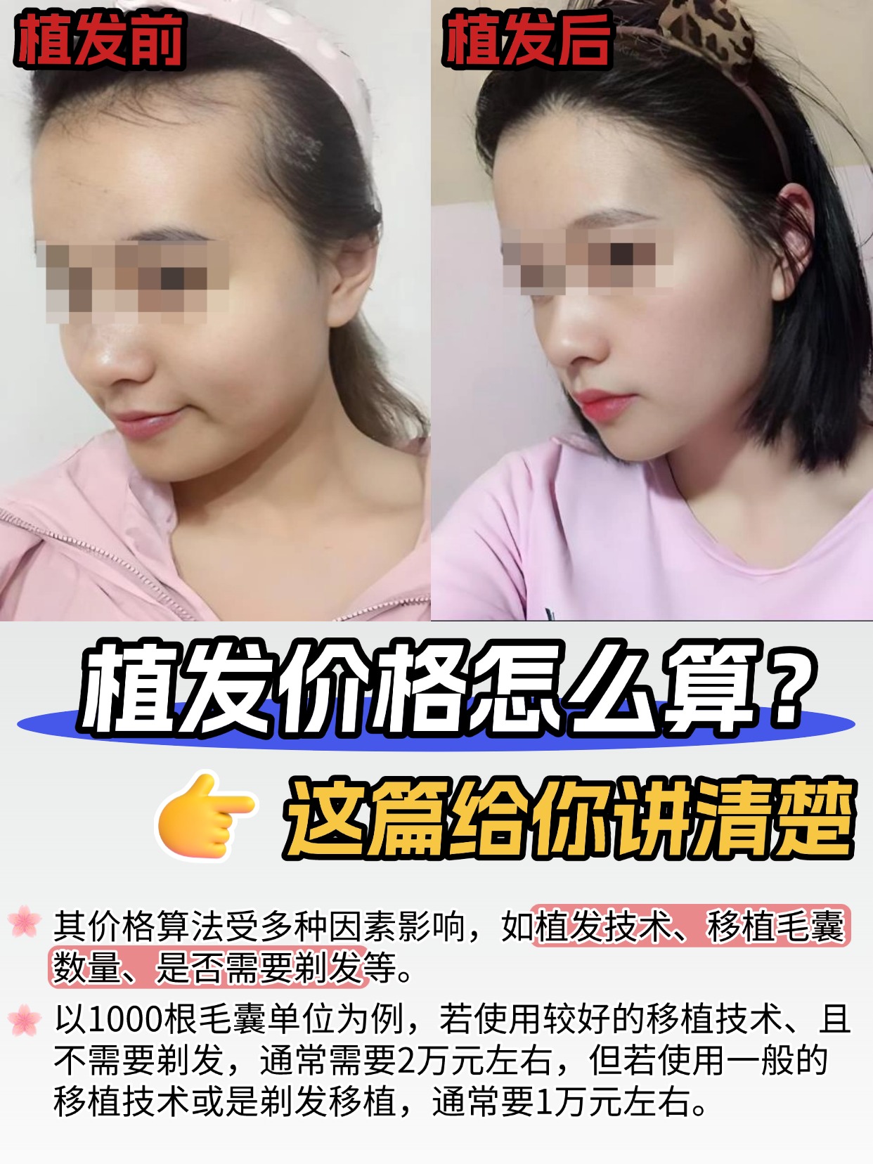 植发价格怎么算?这篇给你讲清楚