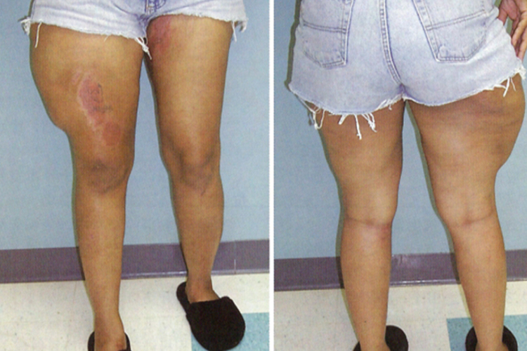 闭合性脱套伤图 闭合性脱套伤图