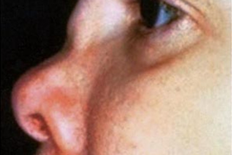 复发性多软骨炎鼻部畸形图 复发性多软骨炎鼻部畸形图