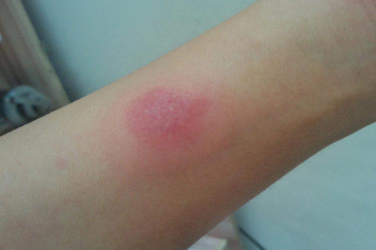 头孢曲松钠皮试过敏图 头孢曲松钠皮试过敏图