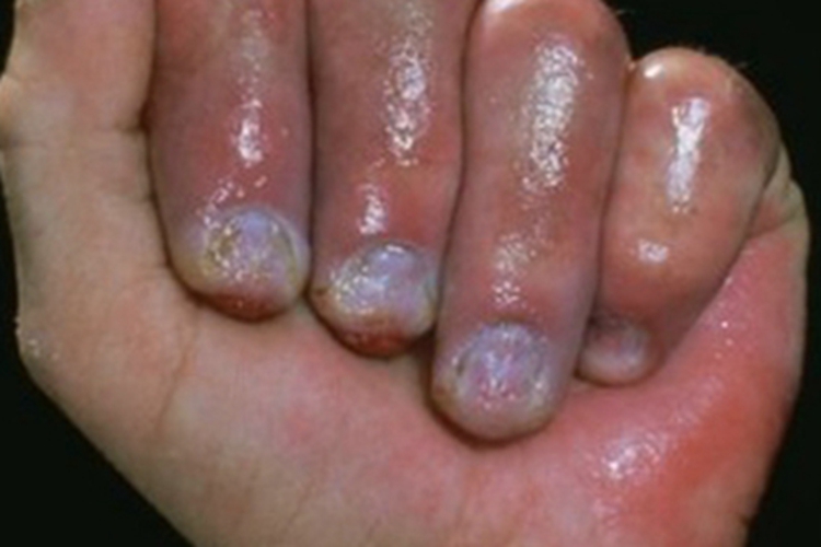 Ⅱ度冻伤手指水泡图